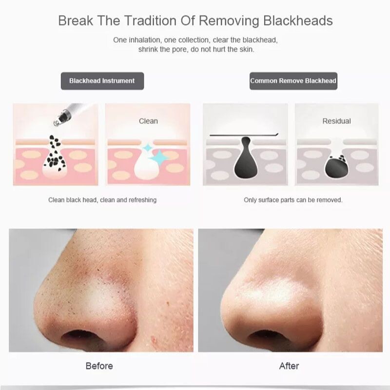 Mitesszer eltávolító porszívó pórustisztító elektromos orr fekete arc mikrodermoabráziós arcgép szépség bőrápolás