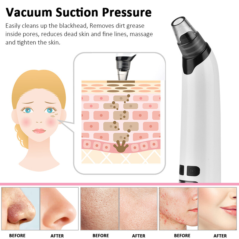 Hot Compress Remover Blackhead Remover αναρρόφησης ακμής καθαριστικό πόρου Ηλεκτρική μύτη Βαθύς καθαρισμός προσώπου Συσκευή περιποίησης δέρματος