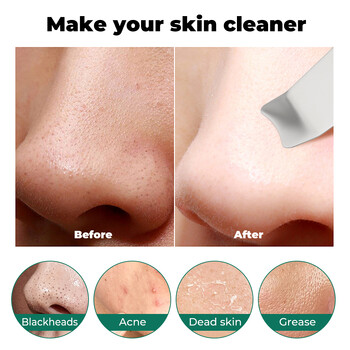 Ultrasonic Skin Scrubber Peeling Remover Blackhead Deep Face Cleaning Ultrasonic Ion Cleaner Pore Cleaner Facial Shovel Cleanser