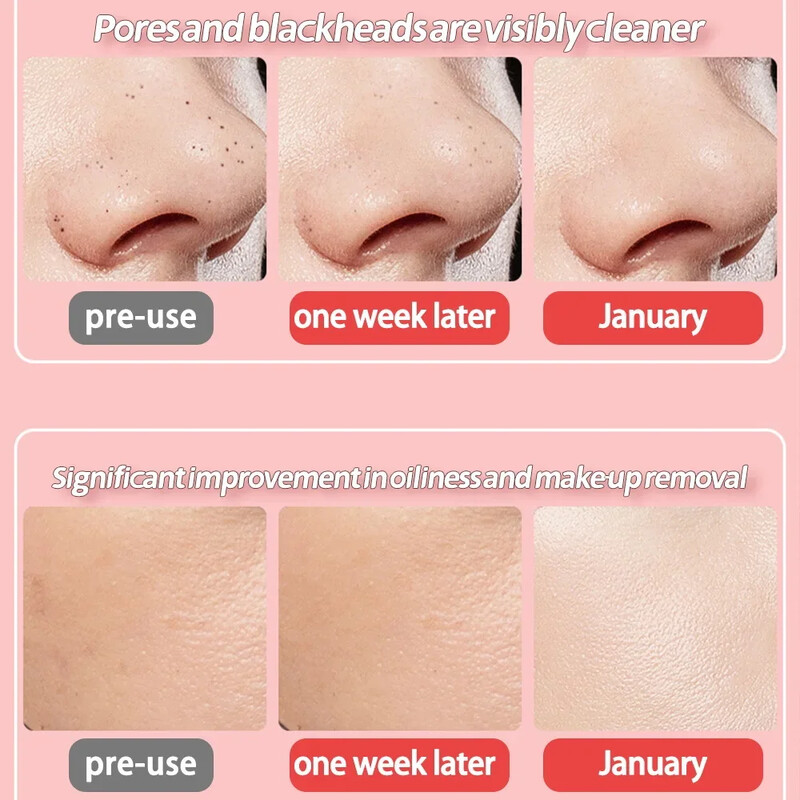 Ultragarsinis odos šveitiklis veido mentele Veido odos šveitiklis ir inkštirų valiklis, porų valiklis, gilus veido valymas