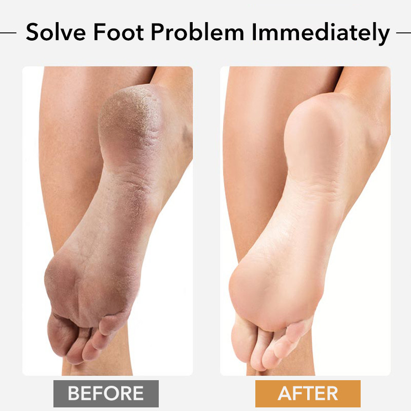 1Gb Profesionāls pedikīra rasp rīks atmirušai ādai, plaisām papēžiem dižskābarža koka pēdas vīle Rasp Callus Remover pēdu skruberis