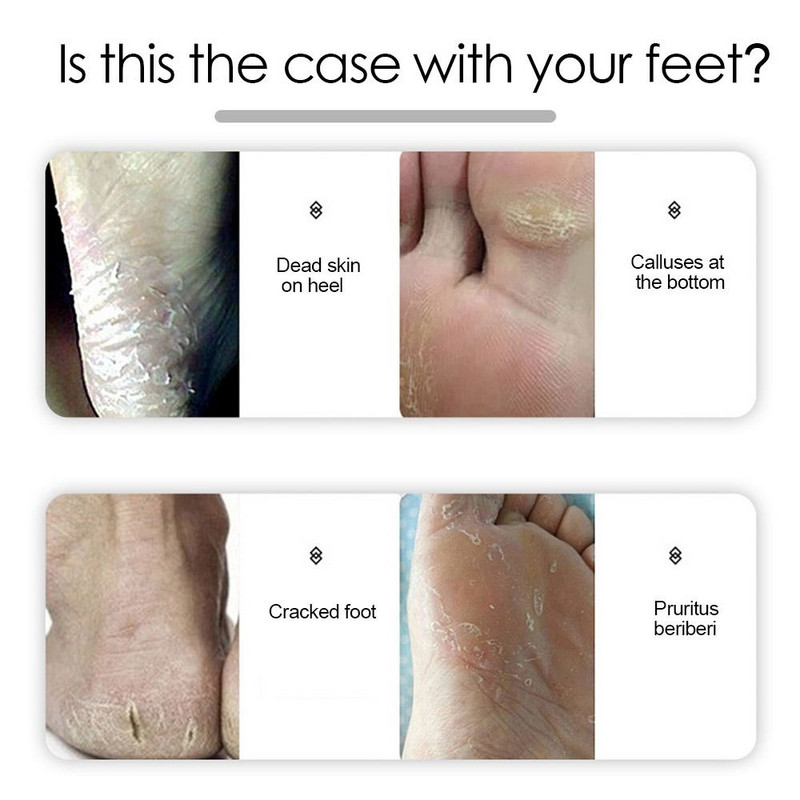 Augstas kvalitātes nerūsējošā tērauda pedikīra vīle Izturīga pīlinga pīlinga noņemšanas līdzeklis pēdu asināšanai Cietās ādas noņemšanas rīki pēdu kopšanai